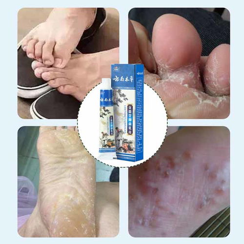 康凈衛(wèi)生用品 專業(yè)止癢噴劑廠家在線咨詢，您的個人衛(wèi)生守護者